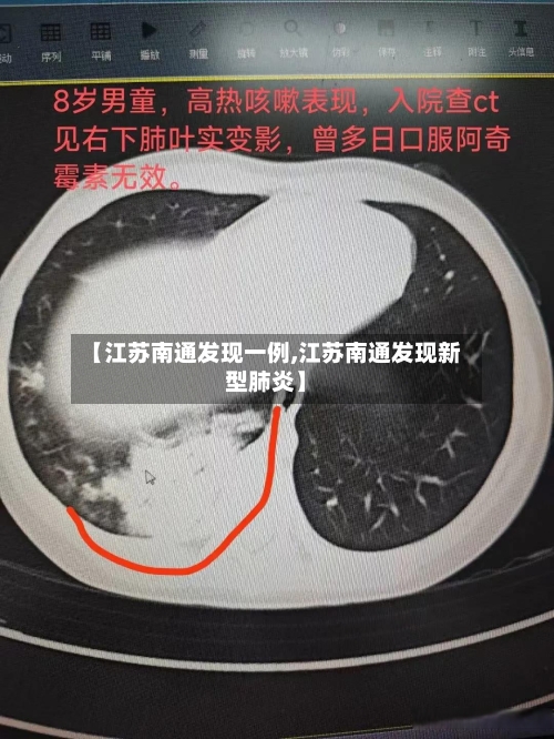 【江苏南通发现一例,江苏南通发现新型肺炎】