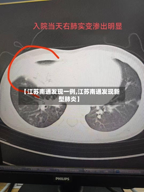 【江苏南通发现一例,江苏南通发现新型肺炎】