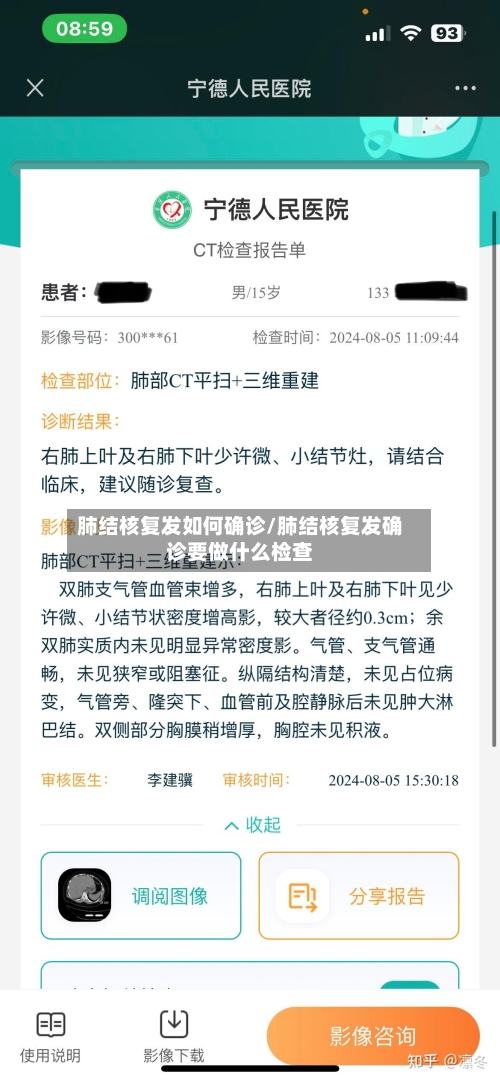 肺结核复发如何确诊/肺结核复发确诊要做什么检查