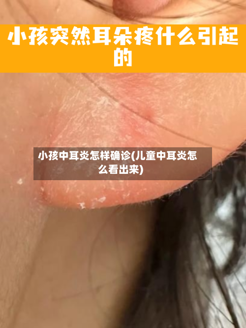 小孩中耳炎怎样确诊(儿童中耳炎怎么看出来)