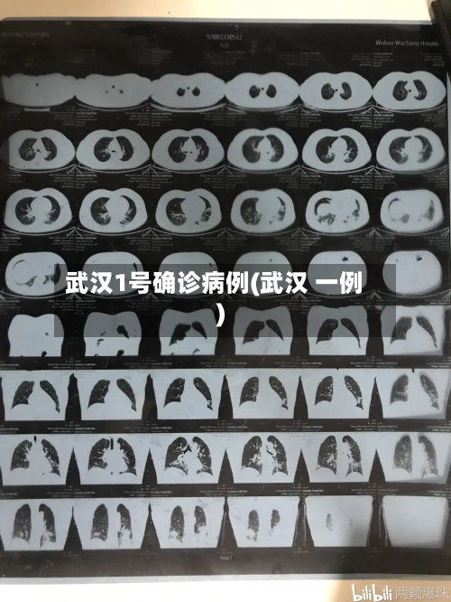 武汉1号确诊病例(武汉 一例)
