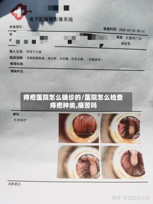 痔疮医院怎么确诊的/医院怎么检查痔疮种类,痛苦吗