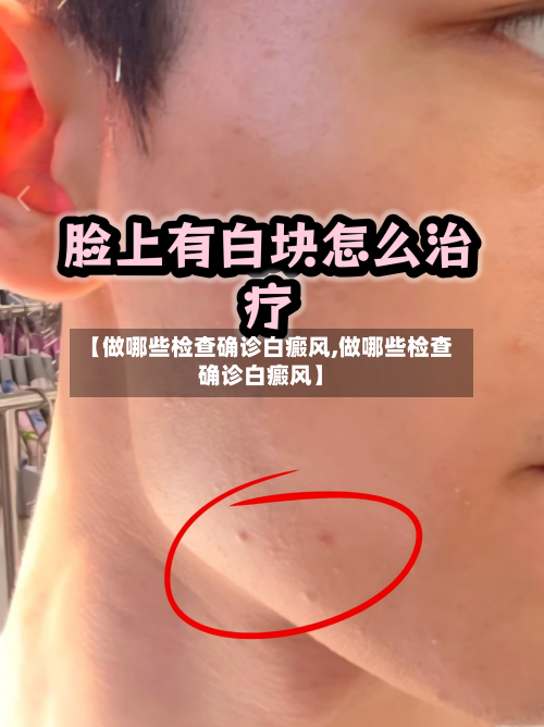 【做哪些检查确诊白癜风,做哪些检查确诊白癜风】
