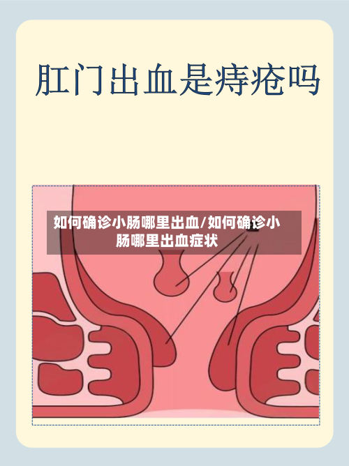 如何确诊小肠哪里出血/如何确诊小肠哪里出血症状
