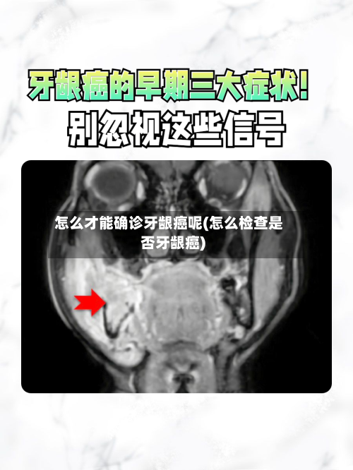 怎么才能确诊牙龈癌呢(怎么检查是否牙龈癌)