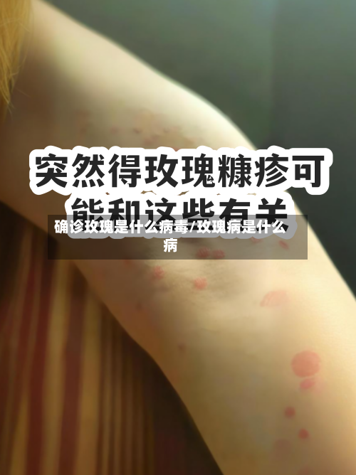 确诊玫瑰是什么病毒/玫瑰病是什么病