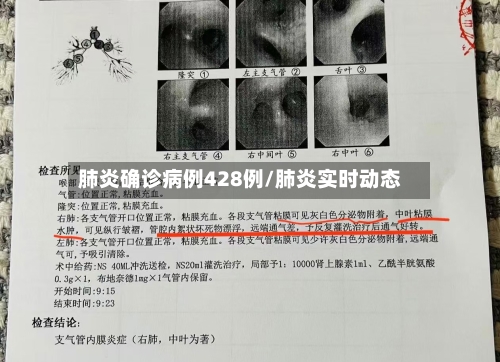 肺炎确诊病例428例/肺炎实时动态