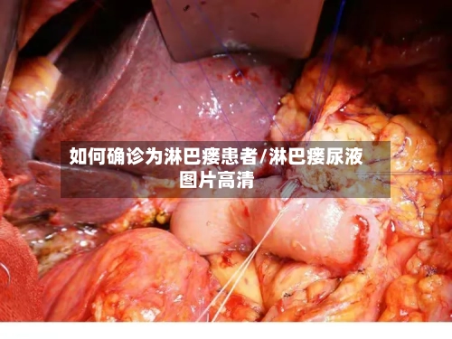 如何确诊为淋巴瘘患者/淋巴瘘尿液图片高清