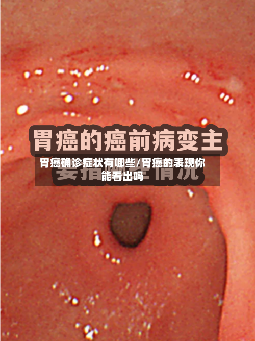 胃癌确诊症状有哪些/胃癌的表现你能看出吗