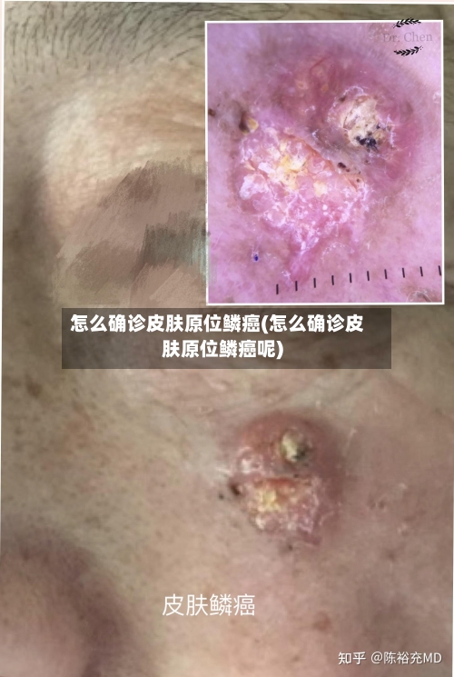 怎么确诊皮肤原位鳞癌(怎么确诊皮肤原位鳞癌呢)