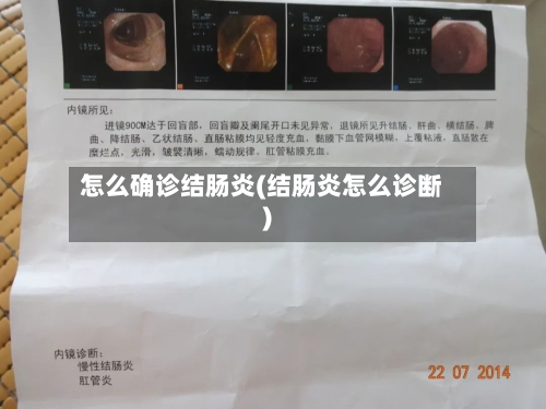 怎么确诊结肠炎(结肠炎怎么诊断)