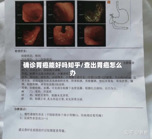 确诊胃癌能好吗知乎/查出胃癌怎么办