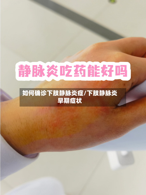 如何确诊下肢静脉炎症/下肢静脉炎早期症状