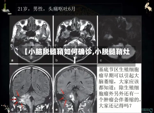 【小脑脱髓鞘如何确诊,小脱髓鞘灶】