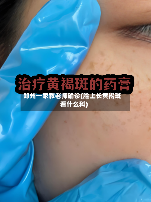 郑州一家教老师确诊(脸上长黄褐斑看什么科)