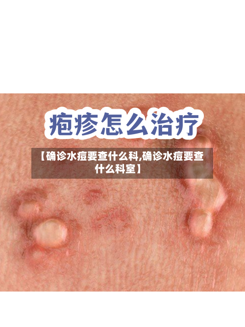 【确诊水痘要查什么科,确诊水痘要查什么科室】